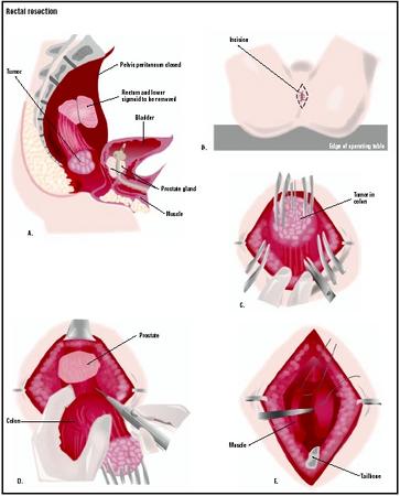 A tumor in the rectum or lower colon can be removed by a rectal resection (A). An incision is made around the patient's anus (B). The tumor is pulled down through the incision (C). An attached area of the colon is also removed (D). The area is repaired, leaving an opening for bowel elimination (E). (Illustration by GGS Inc.)