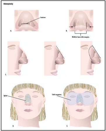During an open rhinoplasty, an incision is made in the skin between the nostrils (A). Closed rhinoplasty involves only incisions inside the nose. Rhinoplasty may involve a change in nostril width (B) or removal of a hump on the nose (C) using bone sculpting. After surgery, a splint supports the nose (D), and a cold compress reduces swelling (E). (Illustration by GGS Inc.)