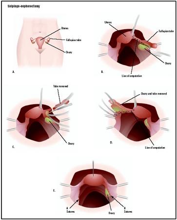 In a salpingo-oophorectomy, a woman's reproductive organs are accessed through an incision in the lower abdomen, or laparoscopically (A). Once the area is visualized, a diseased fallopian tube can be severed from the uterus and removed (B and C). The ovary can also be removed with the tube (D). The remaining structures are stitched (E), and the wound is closed. (Illustration by GGS Inc.)
