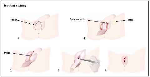 To change male genitalia to female genitalia, an incision is made into the scrotum (A). The flap of skin is pulled back, and the testes are removed (B). The skin is stripped from the penis but left attached, and a shorter urethra is cut (C). All but a stump of the penis is removed (D). The excess skin is used to create the labia (external genitalia) and vagina (E). (Illustration by GGS Inc.)