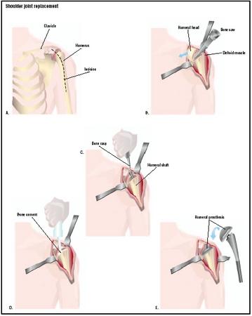 During a total shoulder joint replacement, an incision is first made in the shoulder and upper arm (A). The head of the humerus is removed with a bone saw (B). The shaft of the humerus is reamed with a bone rasp to ready it for the prosthesis (C). After the shoulder joint, or glenoid cavity, is similarly prepared, bone cement is applied to areas to receive prostheses (D). The ball and socket prostheses are put in place, and the incision is closed (E). (Illustration by GGS Inc.)