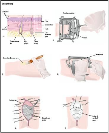 Skin grafts may be used in several thicknesses (A). To begin the procedure, a special cement is used on the donor skin area (C). The grafting machine is applied to the area, and a sample taken (D). After the graft is stitched to the recipient area, it is covered with nonadherent gauze (E) and a layer of fluffy surgical gauze held in place with suture (F). (Illustration by GGS Inc.)