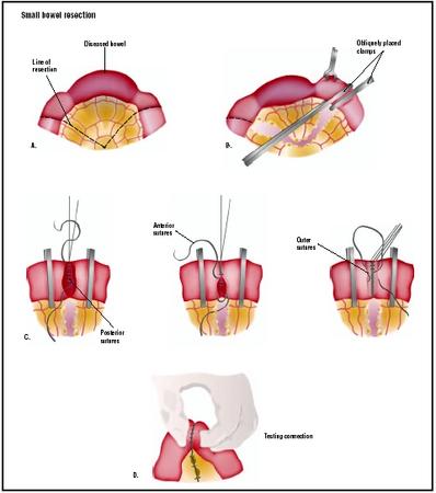 To remove a diseased portion of the small intestine, an incision is made into the abdomen, and the area to be treated is pulled out (A). Clamps are placed around the area to be removed and the section is cut (B). Three layers of sutures repair the remaining bowel (C). (Illustration by GGS Inc.)