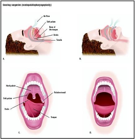 Heavy snorers have their air flow impeded by the structures at the back of the mouth and nose (A and B), which can be alleviated by surgery. In uvulopalatopharyngoplasty, the patient's uvula, soft palate, and tonsils are removed (C and D). (Illustration by GGS Inc.)