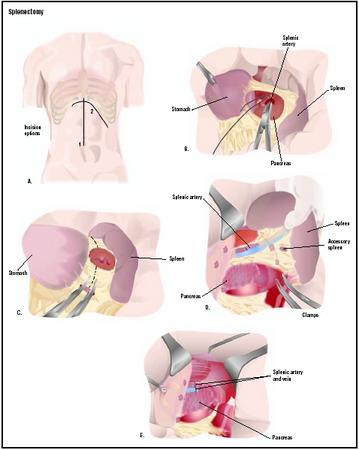 There are two options for accessing the spleen for a splenectomy (A, 1 and 2). After the abdomen is entered, the spleen is located, and the artery leading to it is tied off (B). The ligament connecting the stomach and spleen is cut (C), as is the ligament connecting the spleen and colon (D). This frees the spleen for removal (E). (Illustration by GGS Inc.)