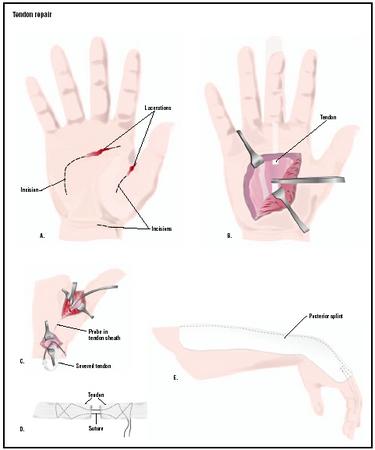 To repair a torn tendon, incisions are made to expose the area for repair (A). Some tendons can be reattached through one incision (B), while others require two to access the severed point and the remaining tendon (C). A special splint that minimizes stretching the tendons may be worn after surgery (E). (Illustration by GGS Inc.)