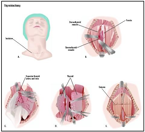 To remove the thyroid gland, an incision is made at the front of the neck (A). Muscles and connecting tissue, or fascia, are divided (B). The veins and arteries above and below the thyroid are severed (C), and the gland is removed in two parts (D). The tissues and muscles are repaired before the skin incision is closed (E). (Illustration by GGS Inc.)