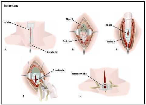 For a tracheotomy, an incision is made in the skin just above the sternal notch (A). Just below the thyroid, the membrane covering the trachea is divided (B), and the trachea itself is cut (C). A cross incision is made to enlarge the opening (D), and a tracheostomy tube may be put in place (E). (Illustration by GGS Inc.)