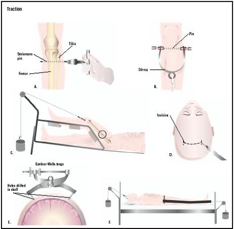 For tibial traction, a pin is surgically placed in the lower leg (A). The pin is attached to a stirrup (B), and weighted (C). In cervical traction, an incision is made into the head (D). Holes are drilled into the skull, and a halo or tongs are applied (E). Weights are added to pull the spine into place (F). (Illustration by GGS Inc.)