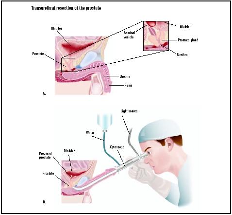 An enlarged prostate can cause urinary problems due to its location around the male urethra (A). In TURP, the physician uses a cystoscope to gain access to the prostate through the urethra (B). The prostate material that has been restricting urine flow is cut off in pieces, which are washed into the bladder with water from the scope (B). (Illustration by GGS Inc.)