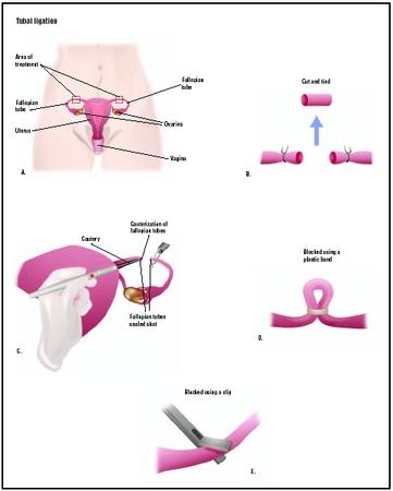 In a tubal ligation, a woman's reproductive organs are accessed by abdominal incision or laparoscopy (A). The fallopian tubes are cut and tied (B), cauterized (C), blocked with a silicone band (D), or clipped (E) to ensure sperm is not able to fertilize an egg. (Illustration by GGS Inc.)