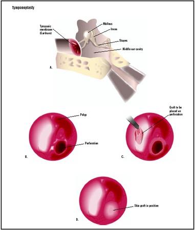The tympanic membrane, or ear drum, may need surgical repair when punctured (A). During a type I tympanoplasty, a perforation in the ear drum is visualized (B). A tissue graft is placed over the perforation (C) and held in place by the existing ear drum (D). (Illustration by GGS Inc.)