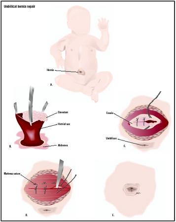 Baby with an umbilical hernia (A). To repair, the hernia is cut open (B), and the contents replaced in the abdomen. Connecting tissues, or fascia, are sutured closed (D), and the skin is repaired (D). (Illustration by GGS Inc.)