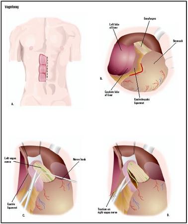 To perform a vagotomy, the surgeon makes an incision in the patient's abdomen (A). The stomach is located (B), and the vagus nerves are cut in turn (C and D). (Illustration by GGS Inc.)